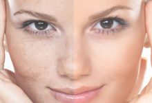 10 kem trị nám tàn nahng hiệu quả trả lại nàng làn da sáng khỏe