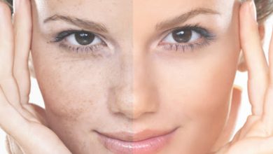 10 kem trị nám tàn nahng hiệu quả trả lại nàng làn da sáng khỏe