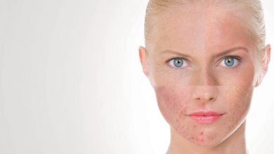 Mách bạn cách giải cứu làn da bị dị ứng mĩ phẩm