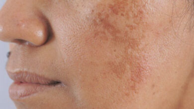 Da bị tăng sắc tố melanin tạo vết thâm trên mặt