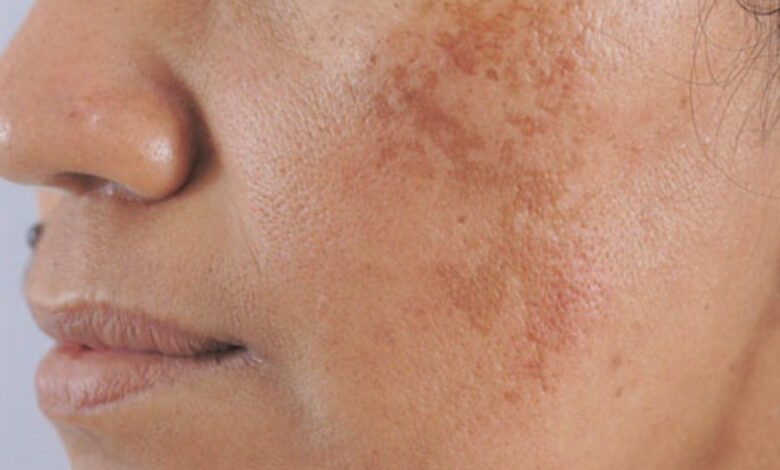 Da bị tăng sắc tố melanin tạo vết thâm trên mặt